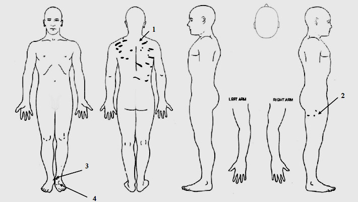 torture victim sketch