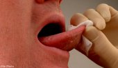 2,500 oral cancer patients diagnosed every year