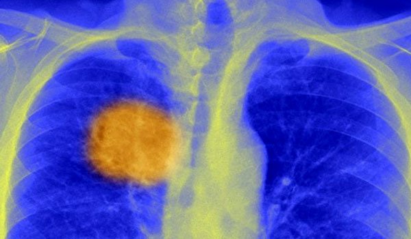 Scientists &#039;find cancer&#039;s Achilles heel&#039;