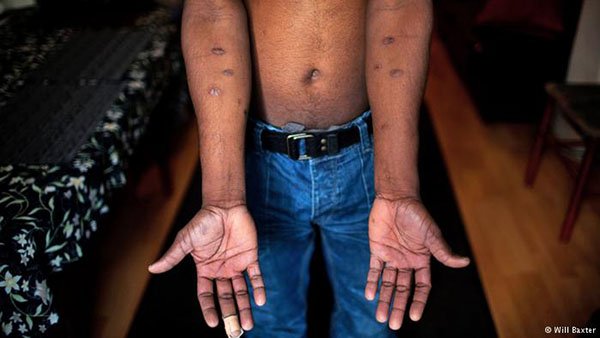 Sri Lanka torture victims call for international war inquiry