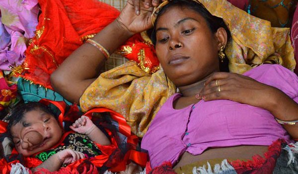 Baby born with &#039;trunk&#039; worshipped as &#039;Ganesha&#039;s wife&#039;